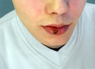 Sífilis, la infección de transmisión sexual que no para de crecer: riesgos y cómo se previene